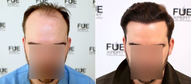 Antes-y-Despues-3100-Injertos-Trasplante-capilar-FUE-Dr-Juan-Couto-en-clinica-capilar-FUExpert-Clinic-Madrid-Espana-1-3