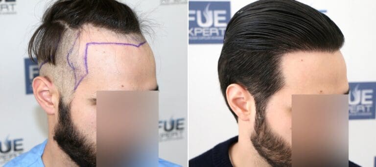 Antes-y-Despues-2204-Injertos-Trasplante-capilar-FUE-Dr-Juan-Couto-en-clinica-capilar-FUExpert-Clinic-Madrid-Espana