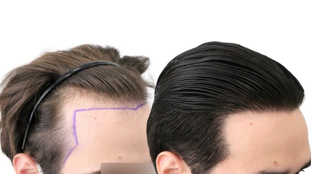Trasplante-Capilar-Frontal-y-Temples-en-FUExpert-Clinic-por-el-Dr-Juan-Couto-en-Madrid-Espana