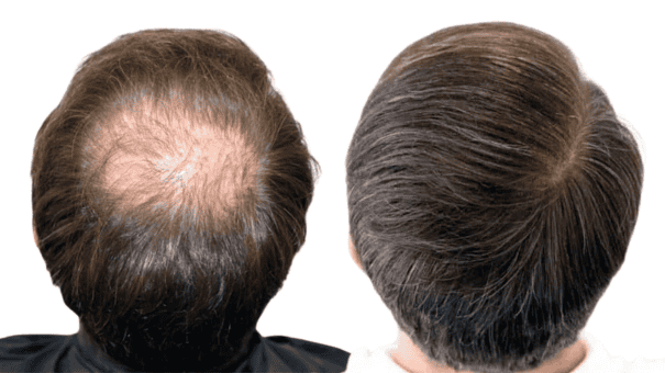 Trasplante-Capilar-Frontal-y-Temples-en-FUExpert-Clinic-por-el-Dr-Juan-Couto-en-Madrid-Espana