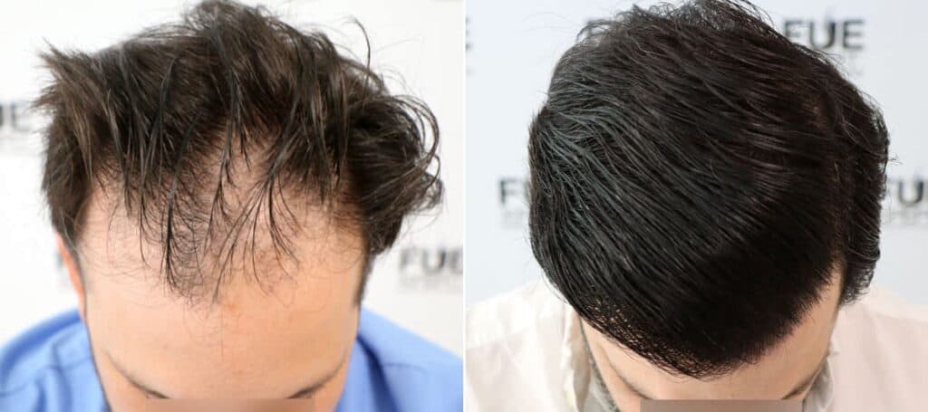 4482 Grafts Injerto Capilar en Madrid por el Dr Juan Couto en FUExpert Clinic